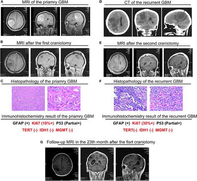 Multidisciplinary Therapy Managed Recurrent Glioblastoma in a BRAF-V600E Mutant Pregnant Female: A Case Report and Review of the Literature